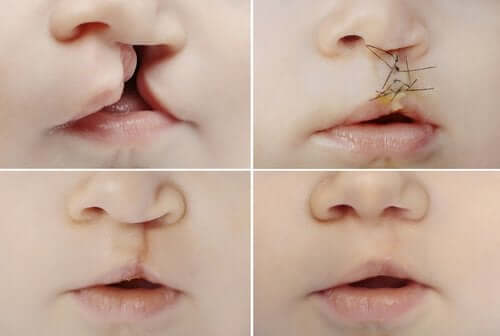 All About Cleft Lip And Cleft Palate Step To Health