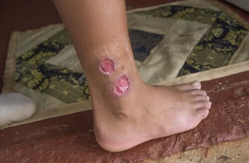 Person med kutan leishmaniasis