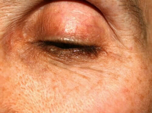 Colored Marks on Eyelids: Why Do They Appear?