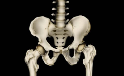 A computerized image of hip dysplasia.