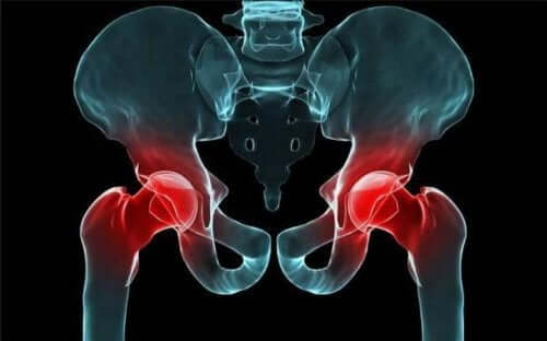 An X-ray of congenital hip dislocation.