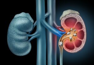Discover The Right Diet for Kidney Stones
