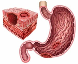 Peptic Ulcers and Helicobacter Pylori