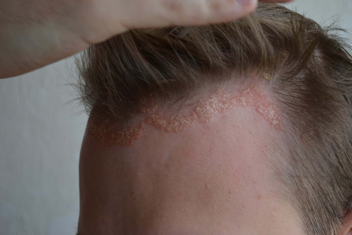 Psoriasis on the scalp.