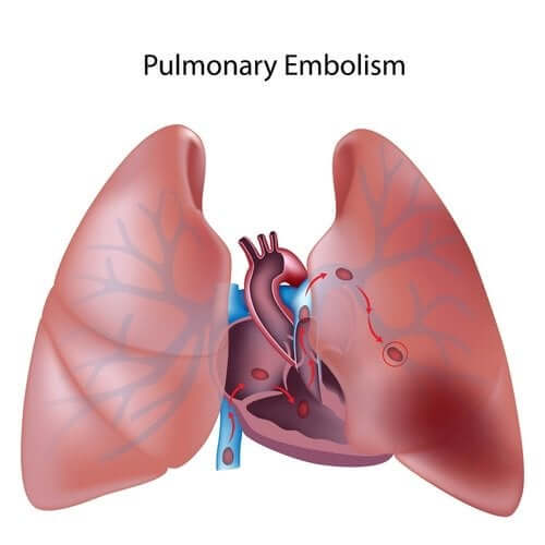 Everything You Need to Know About Pulmonary Thromboembolism