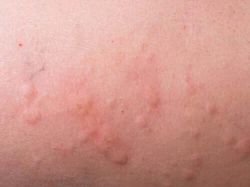 A rash due to roseola.