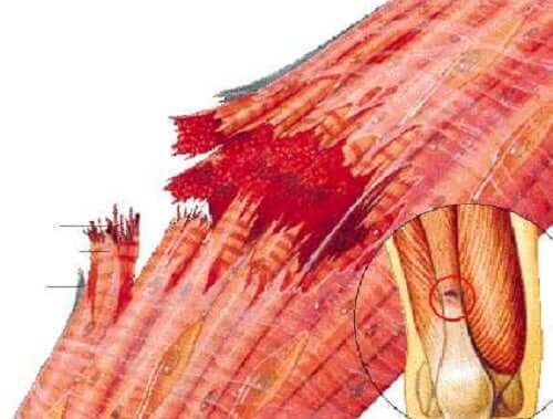 A torn muscle.