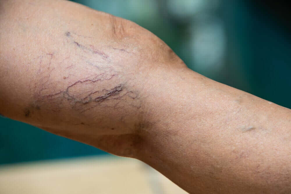 Varicose veins.