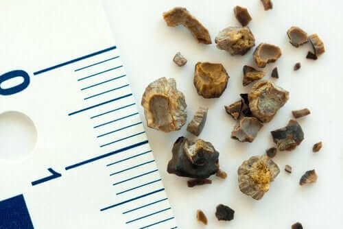 A pile of kidney stones next to a ruler.