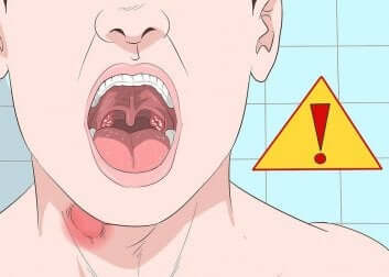 An illustration of cancer sores on the throat.