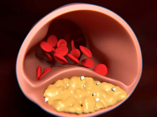 Arteriosclerosis representation.