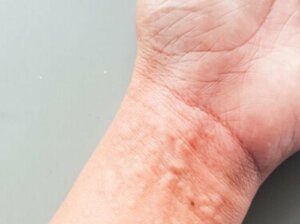 How Chronic Urticaria Affects Your Quality of Life