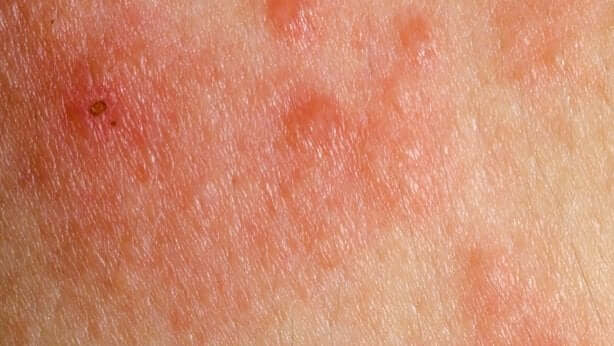Skin irritation from contact with vinegar mixed with bleach.