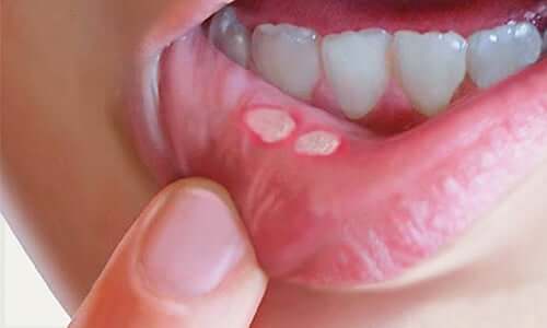 Canker sores in a child's mouth.