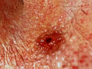 How Many Types of Ulcers Are There?