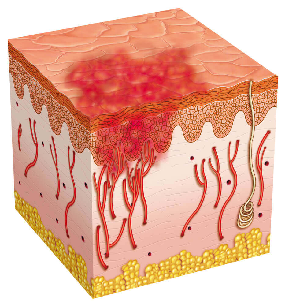 A digital representation of a skin ulcer.