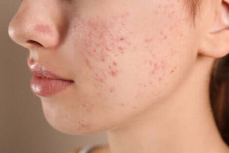 Birth control for skin conditions like acne. 