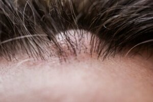 Dermatofibroma: What Is It Exactly?