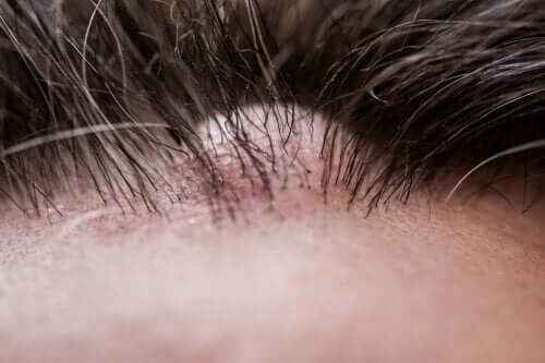 Dermatofibroma: What Is It Exactly?