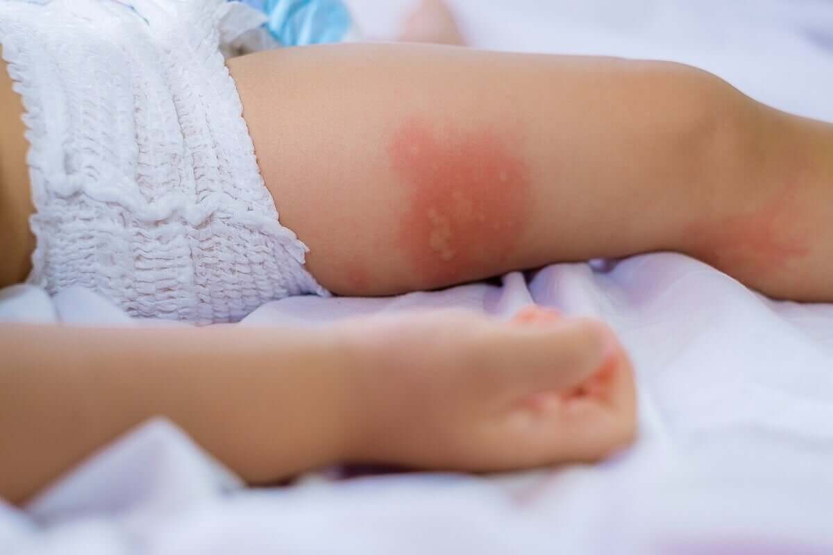 A baby with hives.