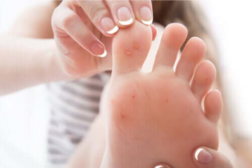 What Are Corns and Calluses and Why Do We Get Them?