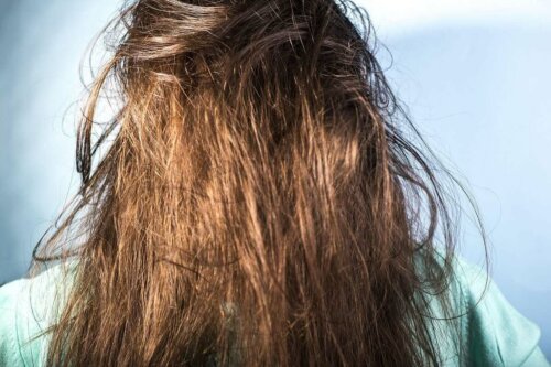 Greasy hair.