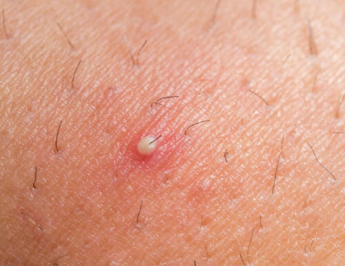An ingrown hair.