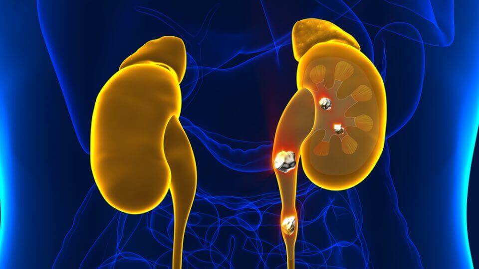 Kidney stones.