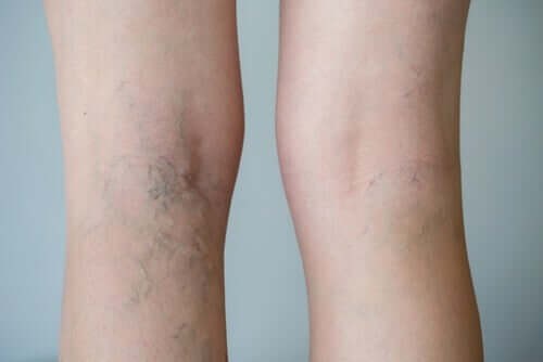 Legs with varicose veins.