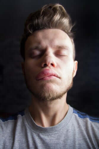 The Causes and Symptoms of Hereditary Angioedema