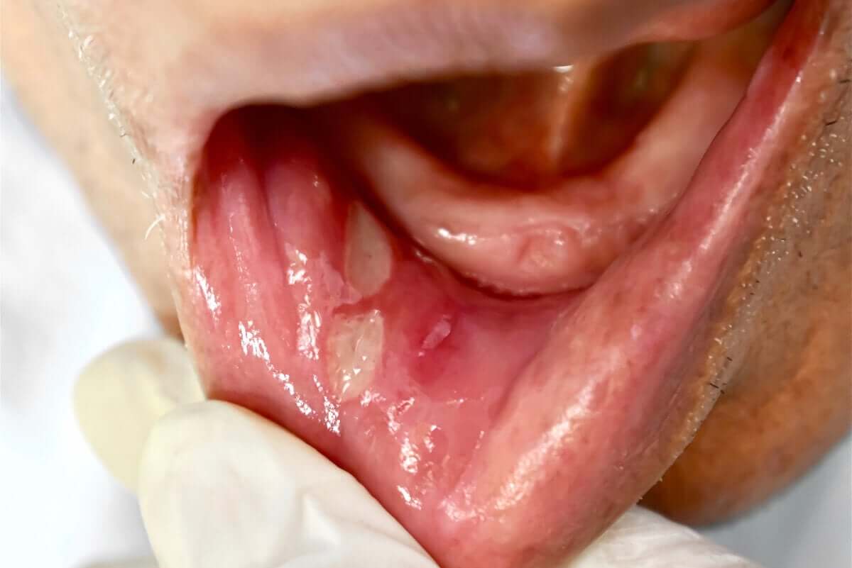 Mouth ulcers on lip.