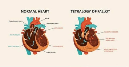 A normal heart vs. a heart with tetralogy of Fallot.