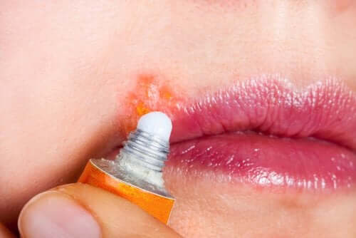 Oral Herpes: Symptoms and Treatment