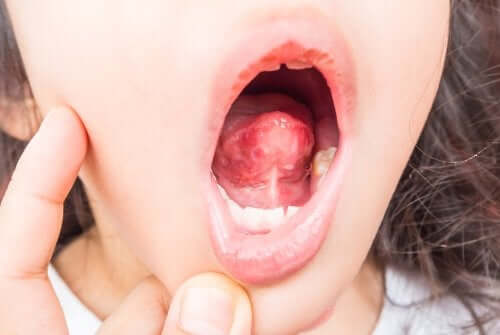 Pimples on the Tongue, How to Remove Them?