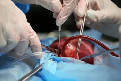 Surgeons operating a congenital heart defect.