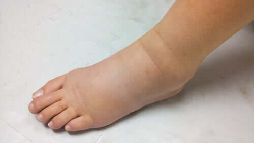 A swollen foot.