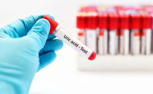 Hyperuricemia: Improve Your Diet to Reduce Uric Acid Levels