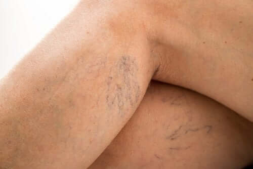 Daflon medication used to treat varicose veins.