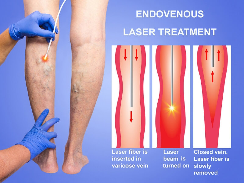 Varicous leg vein.