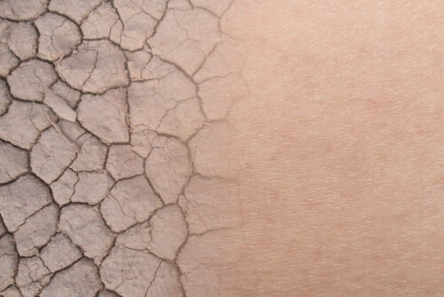A closeup of dry skin.