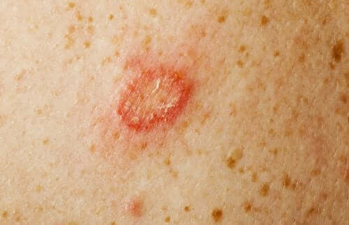 A patch of scaly skin.