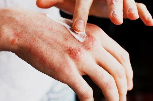 A person applying ointment to a hand rash.