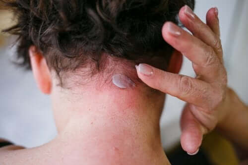Symptoms of Seborrheic Dermatitis and Treatment