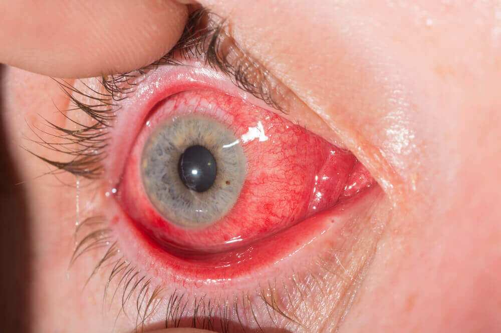 Rodzaje alergicznego zapalenia spojówek