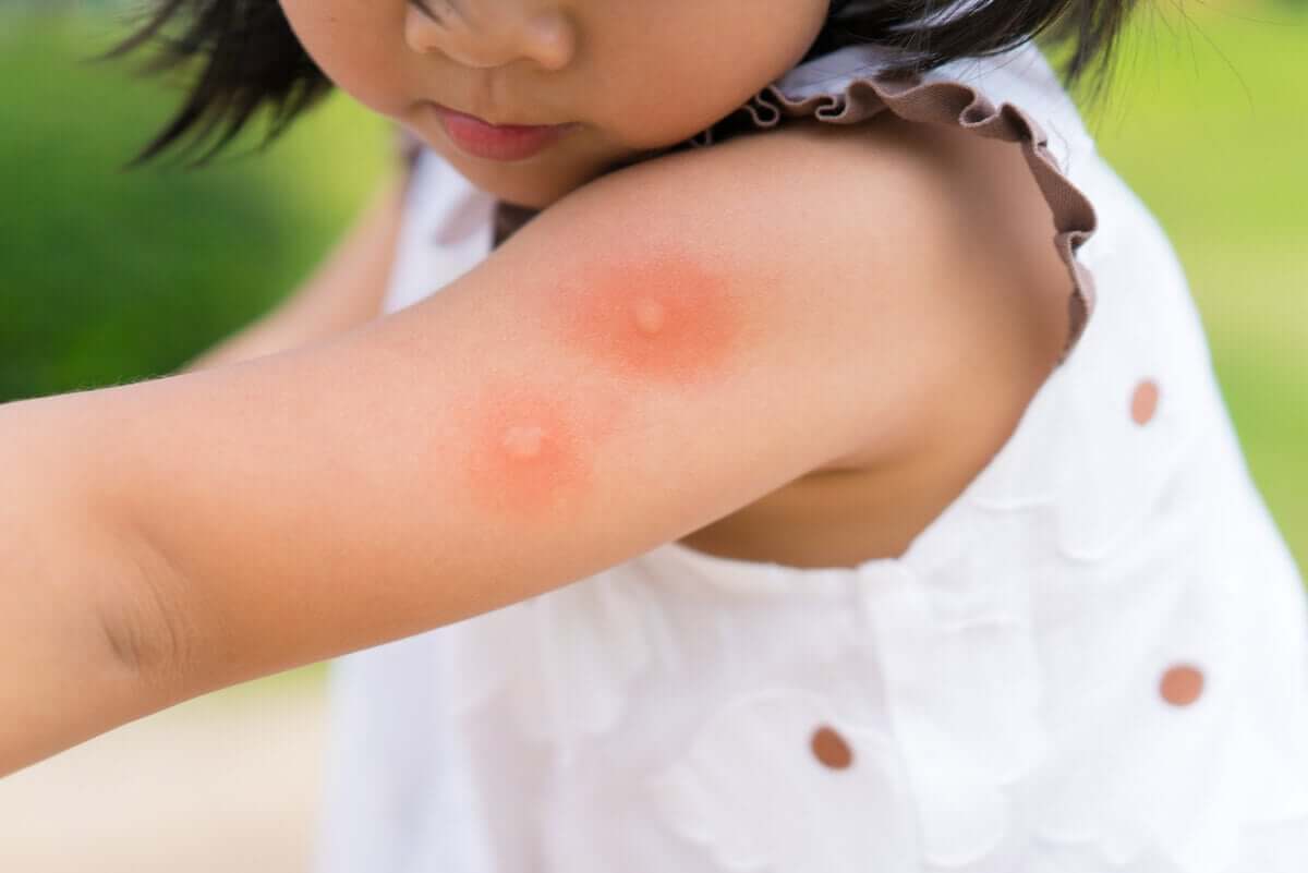 Young girl with mosquito bites on her arm.