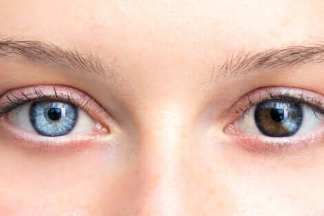Woman with two different color eyes.