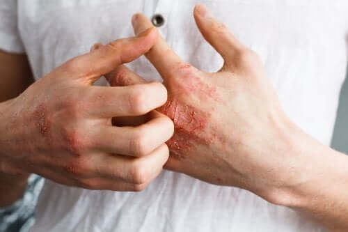 Itchy skin on hands.