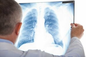 Pulmonary Embolism: Symptoms and Treatment