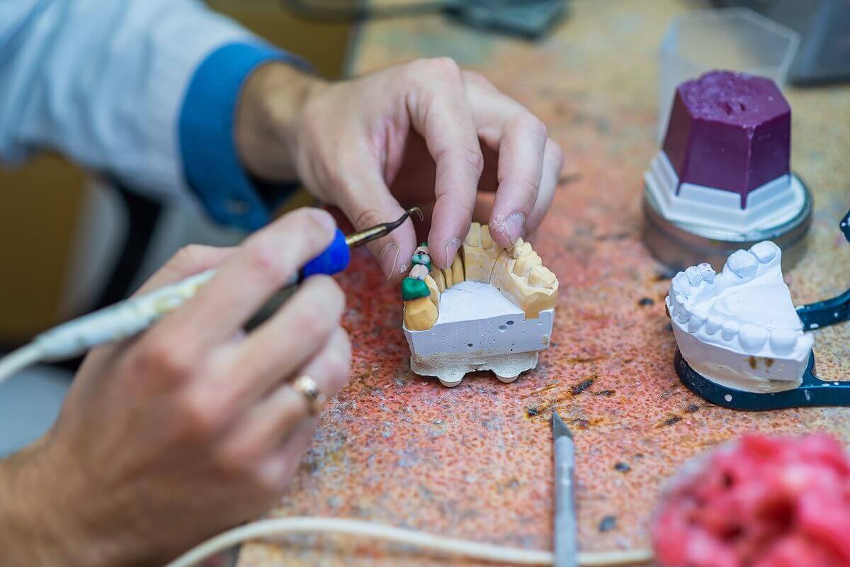 جسر الأسنان: أنواعه وفوائده وعيوبه ؛ أخصائي تقويم الأسنان يصنع جسر أسنان