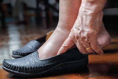 5 Tips For Heat-Related Leg Swelling